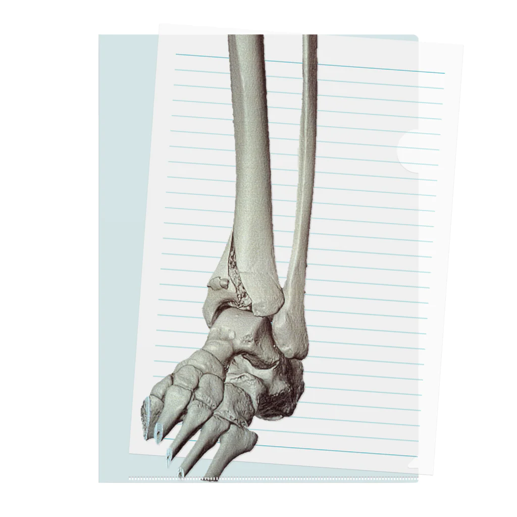 KOBUSHIの左脛骨遠位端骨折CT画像（くり抜き） クリアファイル