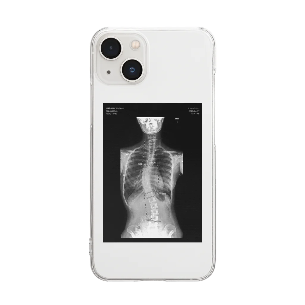 ハ息子の背骨レントゲン Clear Smartphone Case