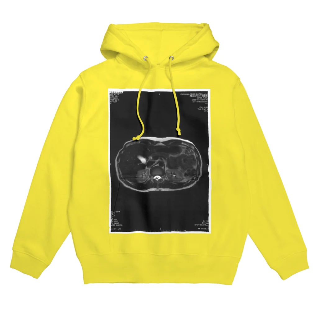 健康診断の俺の輪切りの俺 Hoodie