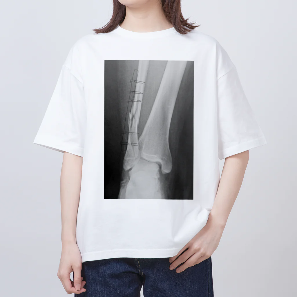 しゃったーみゅーじあむのBroken Leg オーバーサイズTシャツ