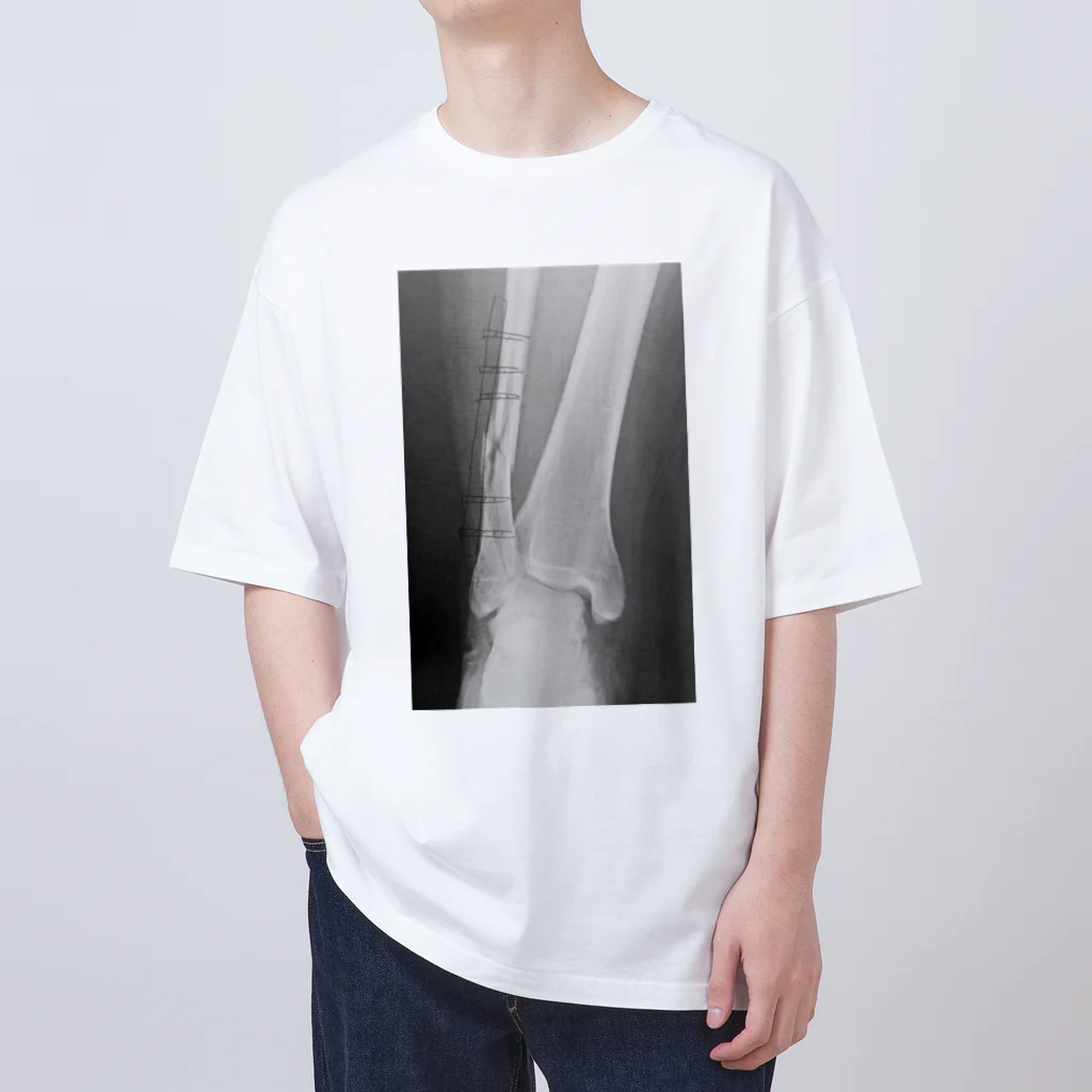 しゃったーみゅーじあむのBroken Leg オーバーサイズTシャツ