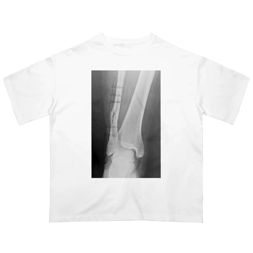 しゃったーみゅーじあむのBroken Leg オーバーサイズTシャツ