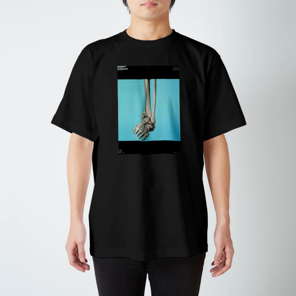 KOBUSHIの左脛骨遠位端骨折CT画像 スタンダードTシャツ