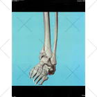 KOBUSHIの左脛骨遠位端骨折CT画像 くるぶしソックス