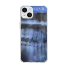壊死の歯レントゲン2022年11月 Soft Clear Smartphone Case