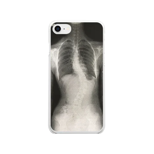 ガチレントゲン(側弯症) Clear Smartphone Case