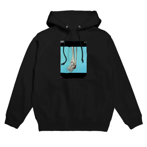 左脛骨遠位端骨折CT画像 Hoodie