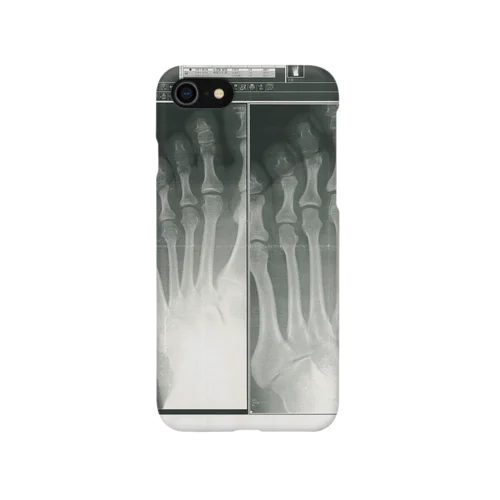 X-ray step Smartphone Case