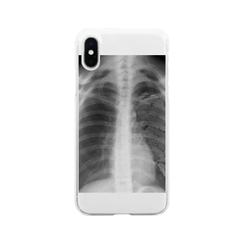 あの子の肺 Soft Clear Smartphone Case